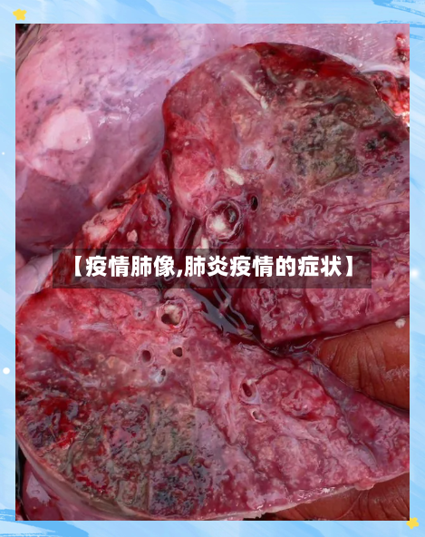 【疫情肺像,肺炎疫情的症状】-第2张图片